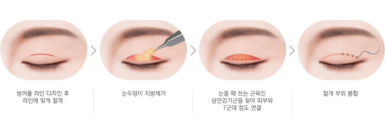 천안 눈성형 압구정라인 절개법 수술과정