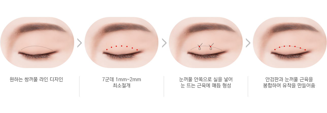 천안 눈성형 안검하수 수술과정